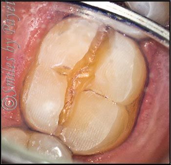 Close-up view of a tooth with a deep crack in the grooves. Amber/brown discoloration.