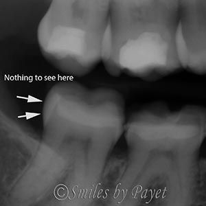 Dental X-ray showing teeth with text