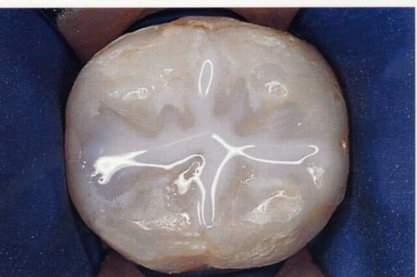 Close-up of a restored tooth. Light-colored filling with a cross-shaped groove in the center.