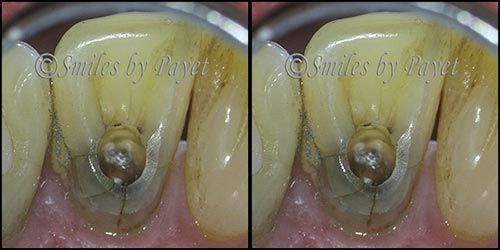 Close-up of a tooth with a dental preparation, showing the inside. Yellowish color.