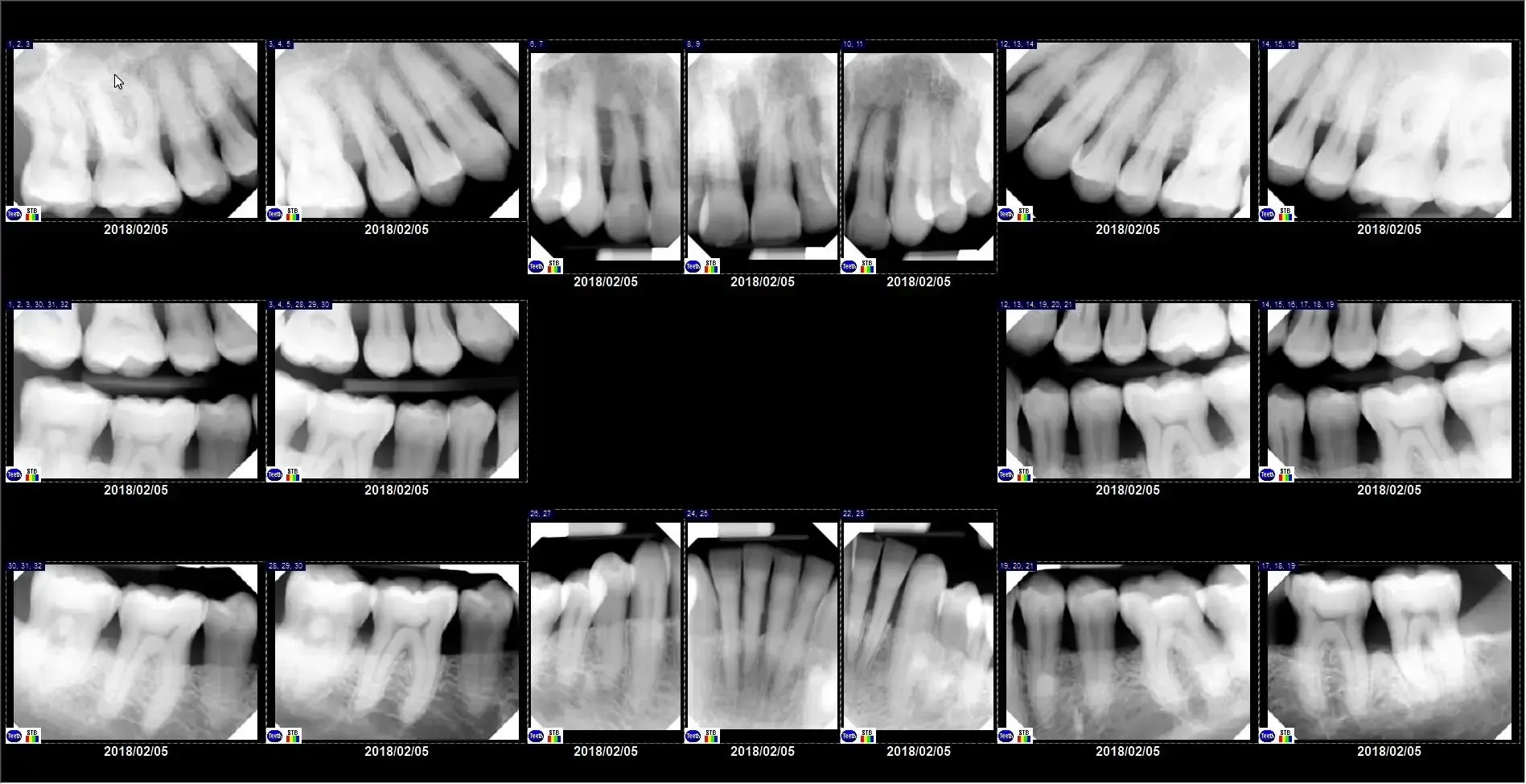 Dental X-ray images, showing various teeth, in a panoramic view.