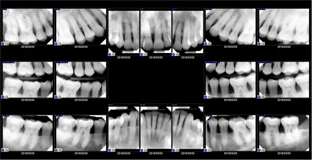 Dental X Ray Fmx