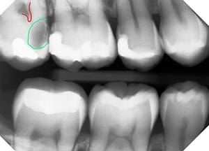 Dental X-ray showing upper and lower molars. A green circle outlines a suspected cyst near the upper left molar.