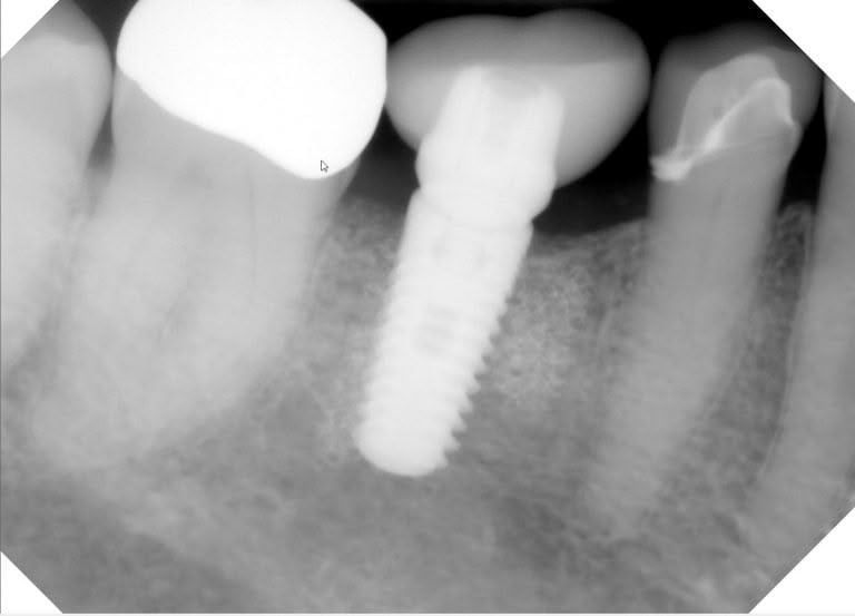 Dental X-ray showing a tooth implant with a crown, and adjacent teeth with fillings.