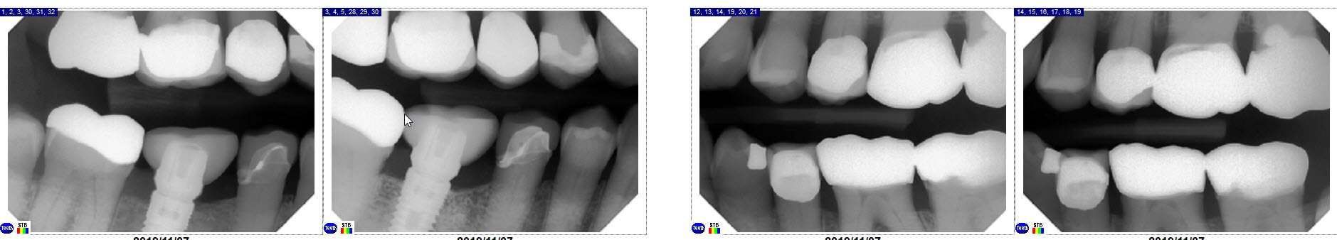 4 bitewing x-rays showing dental crowns, fillings, and a dental implant
