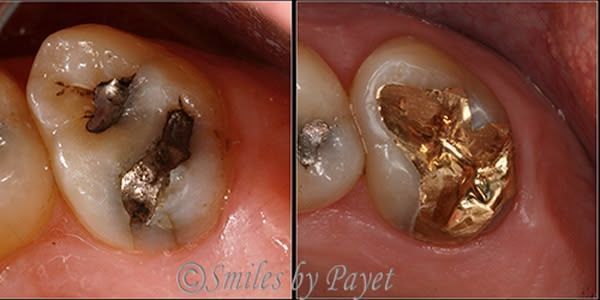Dental images: a tooth with old fillings and another with a gold inlay.