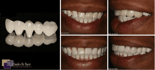 Dental bridge and after-treatment smile. Close-ups of teeth before and after the procedure.