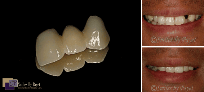 Dental bridge and smile transformation. Before and after photos show gap filled.