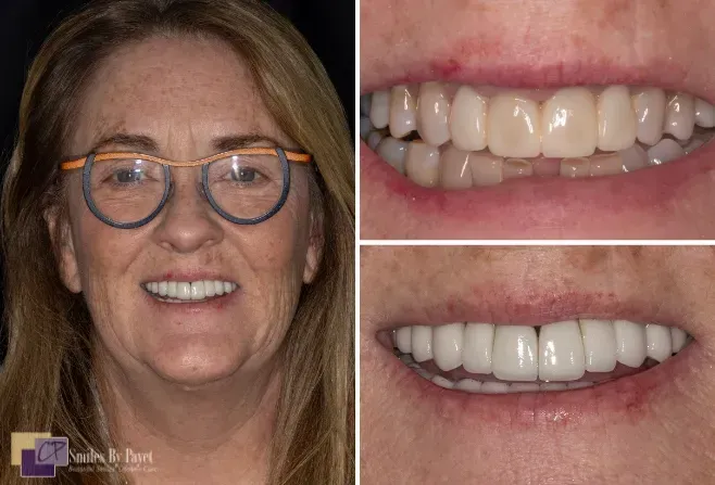 Woman smiling, showcasing dental work. Comparisons show before and after teeth whitening and alignment.