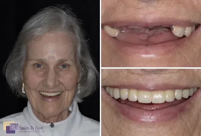 Woman's smile transformation: Before, revealing missing teeth; after, showing full, natural-looking dentures.