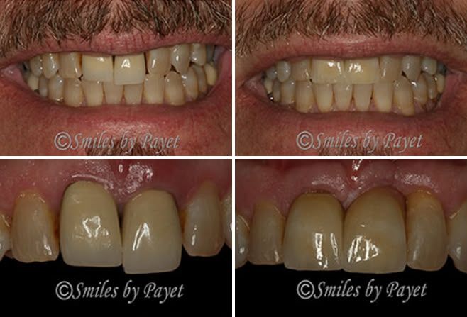 Side-by-side dental comparisons: upper teeth before/after; close-up of front teeth before/after cosmetic dental work.