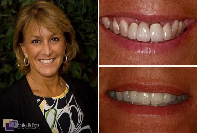 Woman smiling, with inset photos of teeth: before and after cosmetic dentistry.