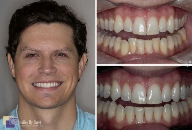 Man smiling with a bright white smile, before and after shots of his teeth.