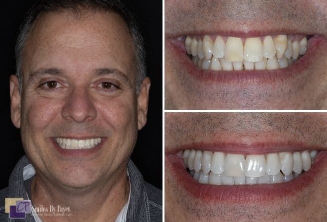 Man smiles before and after dental work, showing whiter teeth.