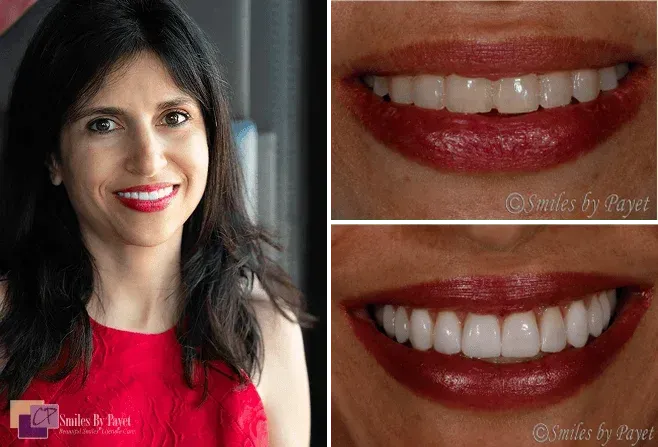 Woman in red smiling, with close-ups of her smile showcasing white teeth, comparing before and after views.