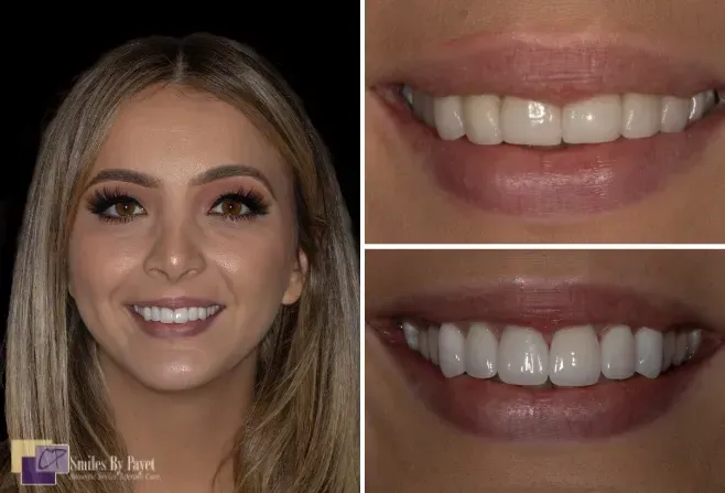 Woman smiling with white teeth, with two close-up photos of her smiling.