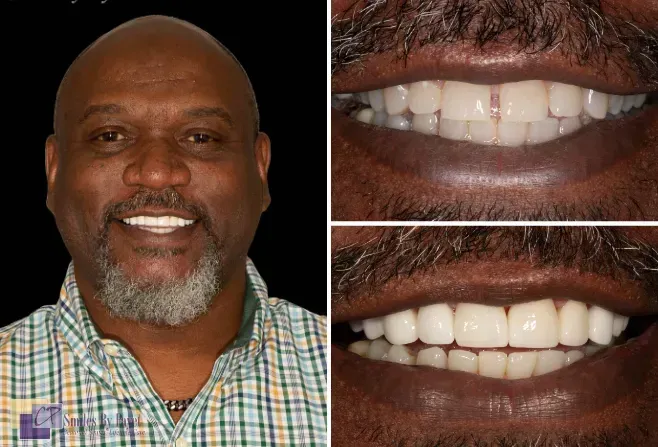 Man with a bright smile. Close-up photos show his upper and lower teeth, appearing whiter.