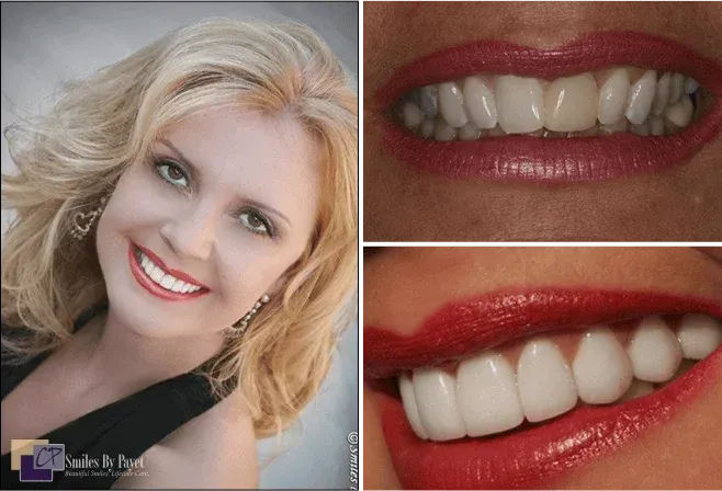 Woman with bright smile; close-ups of perfect white teeth. Red lipstick.