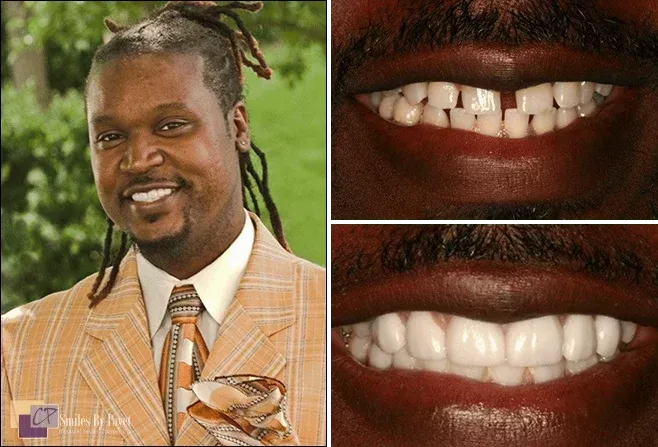 Man smiling with before and after images of teeth, showing improvement.