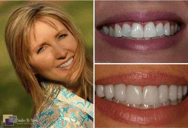 Woman smiling, with two close-ups of bright, white teeth, showcasing cosmetic dentistry.
