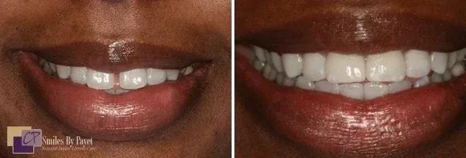 Comparison of teeth before and after cosmetic dentistry. Whitening and reshaping.
