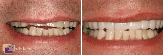 Before-and-after of a person's teeth, with a damaged smile on the left and a repaired smile on the right.