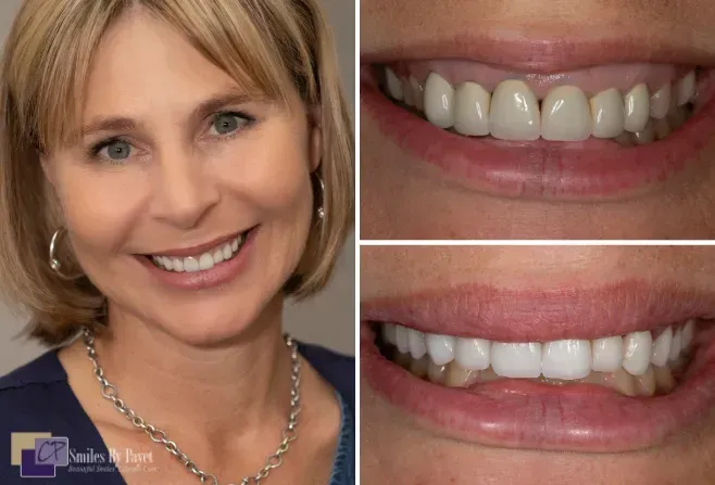 Woman smiling with two close-ups of teeth: before and after cosmetic dentistry; white teeth, pink lips.