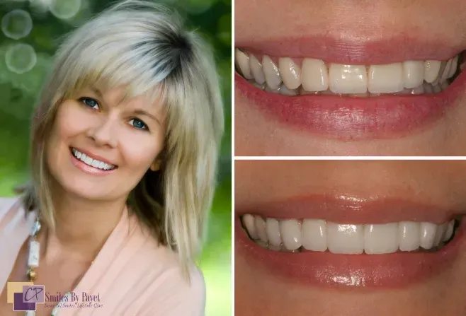 Woman smiling with before-and-after close-ups of her teeth after a dental procedure.