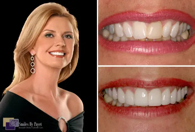 Woman smiling with before and after images of teeth whitening.