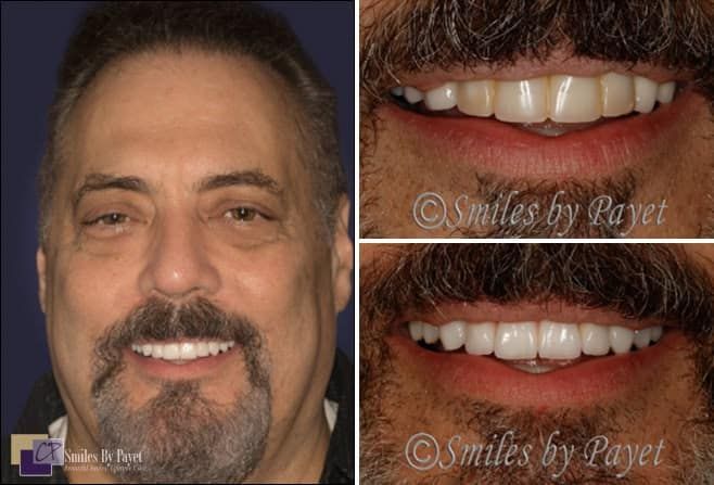 Man with before and after smile comparison. New teeth appear whiter and straighter.
