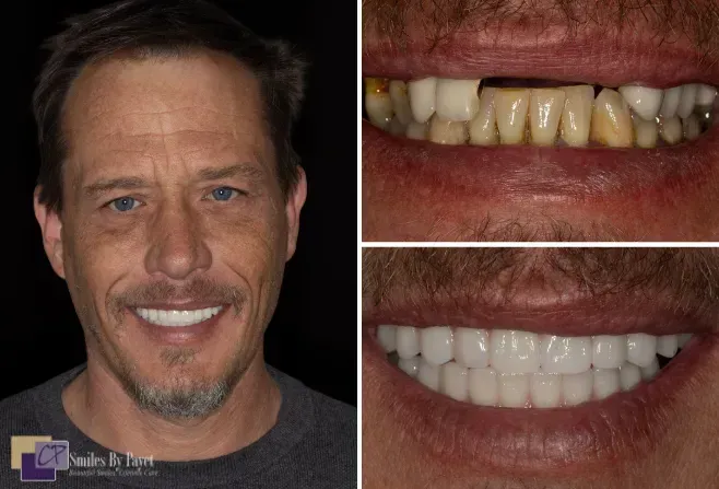 Man with a smile, dental before and after photos showing stained and missing teeth versus bright, aligned teeth.