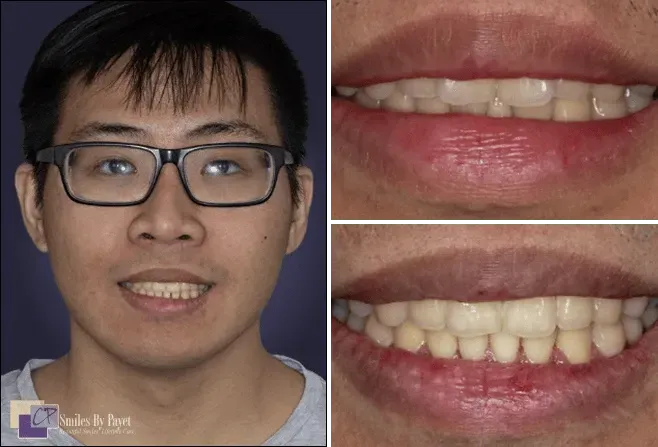 Man with glasses smiling, two close-ups of smiling mouths, teeth whitening before and after shots.