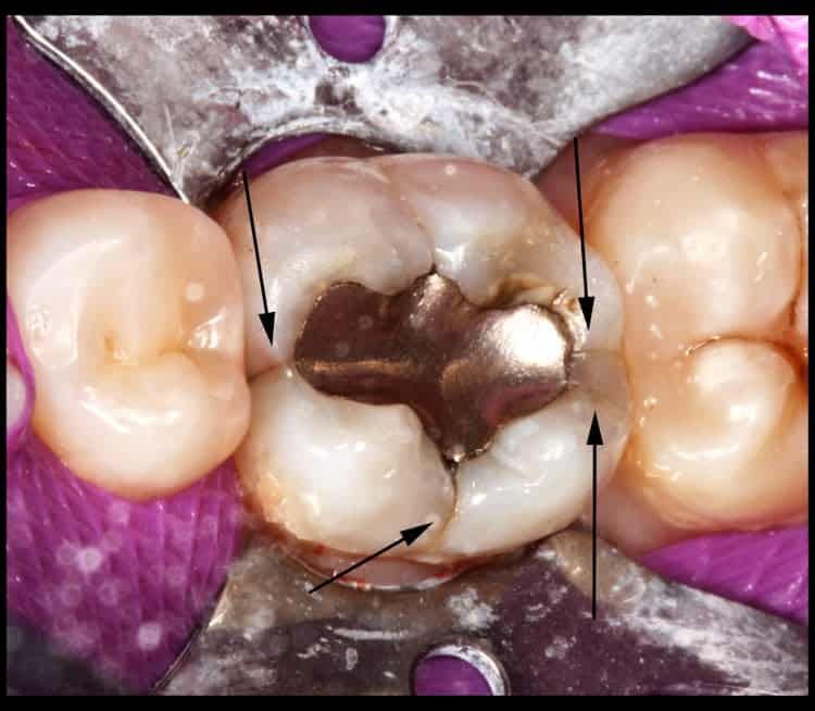 Dental view of a molar with a silver amalgam filling, surrounded by a rubber dam and adjacent teeth.