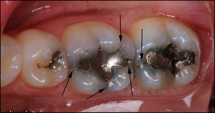 Close-up of teeth with silver fillings and arrows pointing to areas of the teeth.