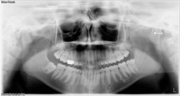 Panoramic dental X-ray showing upper and lower teeth, jaw, and sinuses.