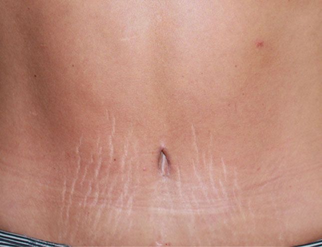 Tummy Tuck