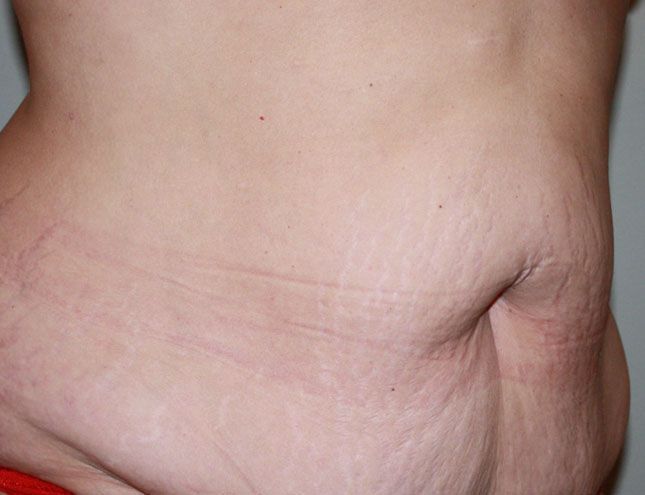 Tummy Tuck