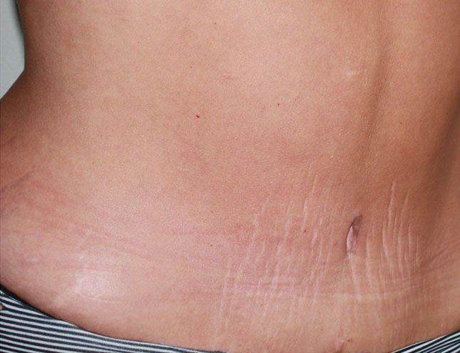 Tummy Tuck