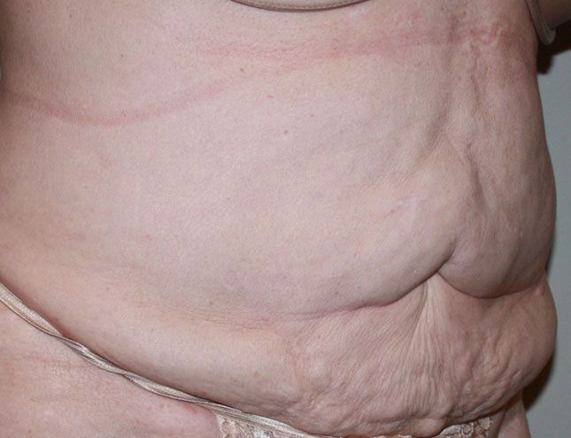 Tummy Tuck