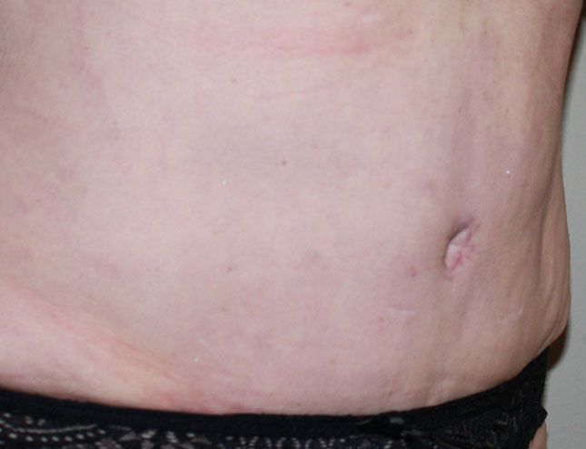 Tummy Tuck
