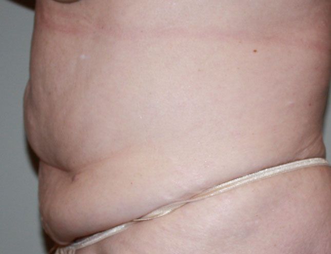 Tummy Tuck