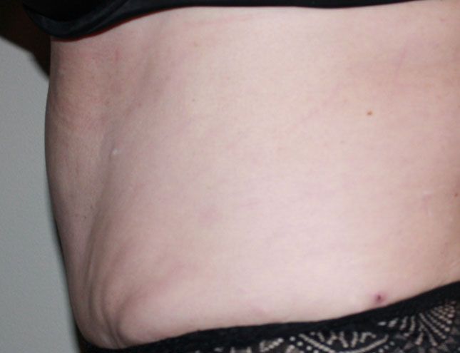 Tummy Tuck