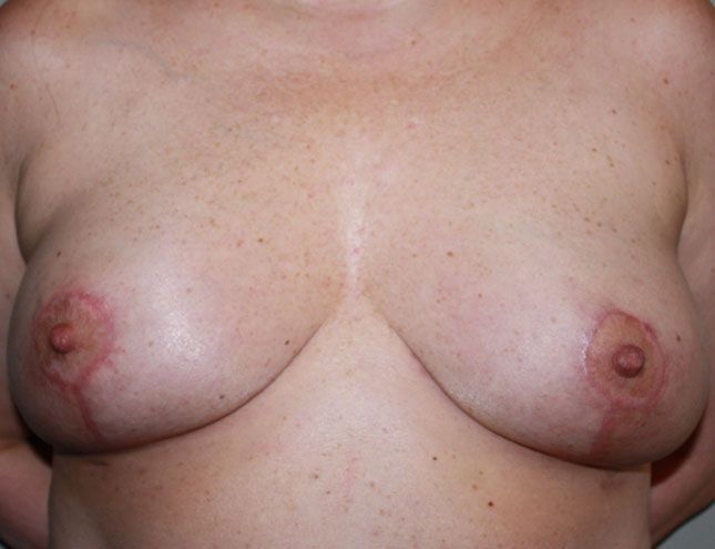 Breast Lift 