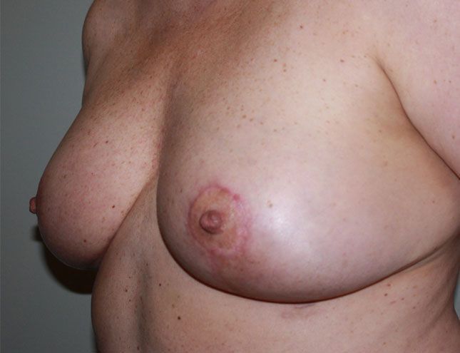 Breast Lift 