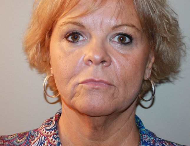 Neck Lift/Deep Laser 