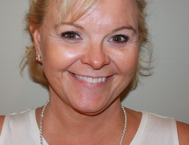 Neck Lift/Deep Laser 