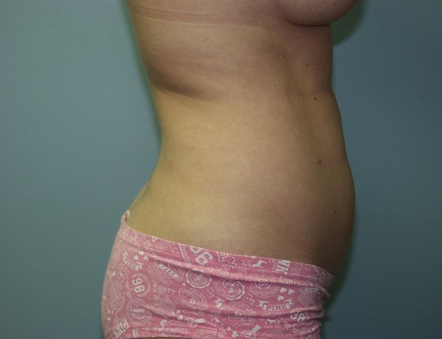 Liposuction