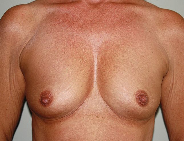 Breast Augmentation