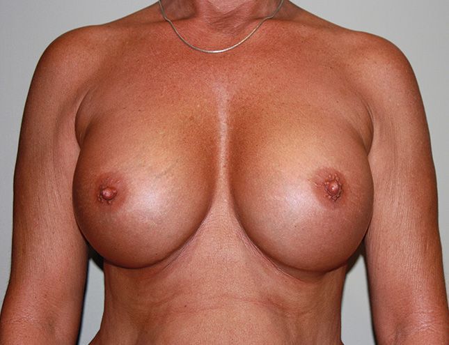 Breast Augmentation