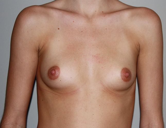 Breast Augmentation